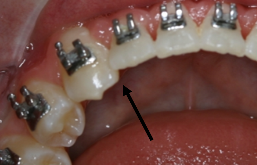 Top Orthodontic Finishing Mistakes to Avoid A Guide by Dr. Jeffery Taylor